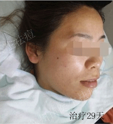 我的战痘历程