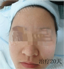 苏州苗医生祛痘，让我从“校疤”变校花