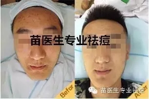 小伙“祛痘记”-苗医生祛痘日记