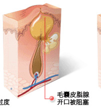 常州祛痘专家介绍-毛囊皮脂腺开口被阻塞