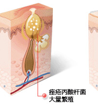 常州祛痘专家介绍-痤疮丙酸杆菌大量繁殖