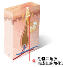 常州祛痘专家介绍-毛囊口角质形成细胞角化过度