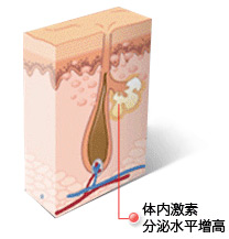 常州祛痘专家介绍-体内激素分泌水平增高