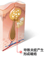 常州祛痘专家介绍-导致炎症产生,形成暗疮